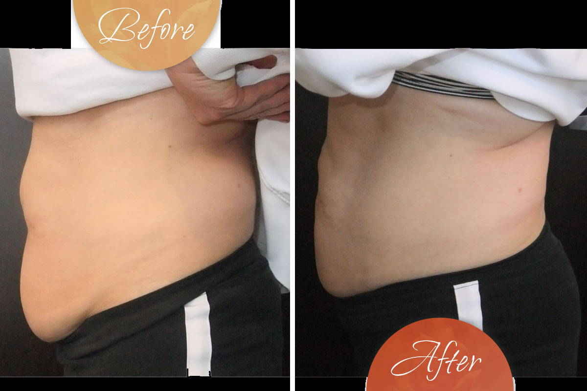 liposuction-unwanted-fat-removal